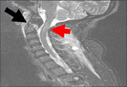 Suzette's MRI Image